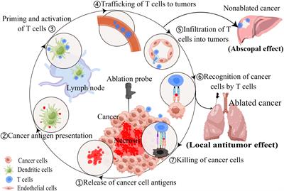 Potential biomarkers for predicting immune response and outcomes in lung cancer patients undergoing thermal ablation